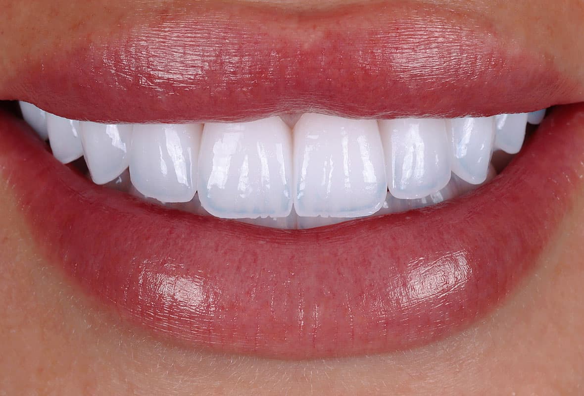 After treatment