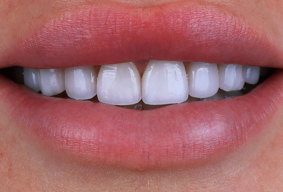Before treatment