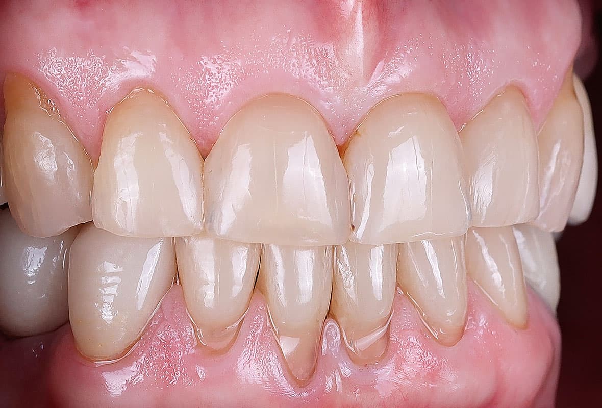 Before treatment