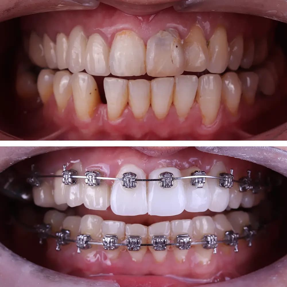 Crossbite to arch