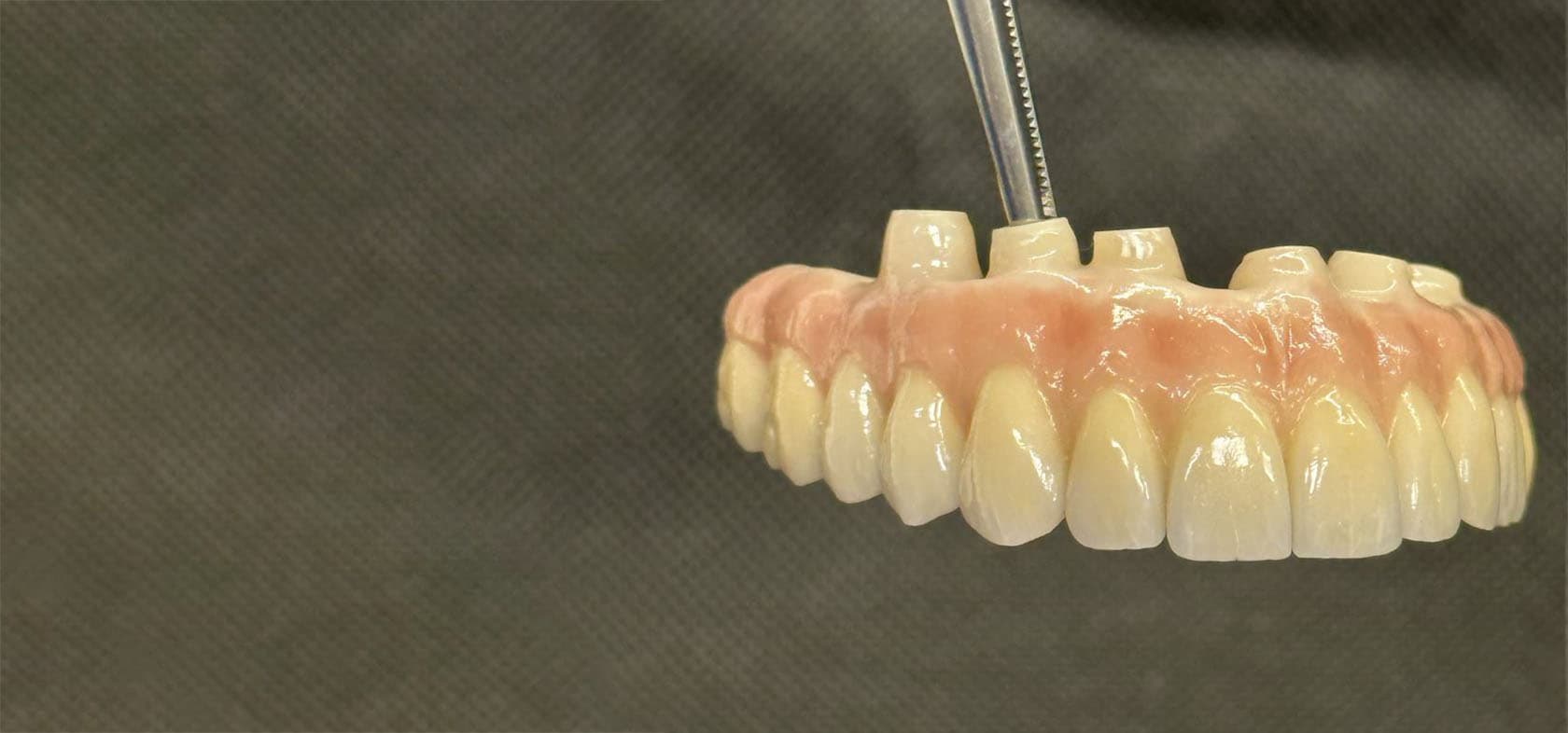 A full-arch prosthesis