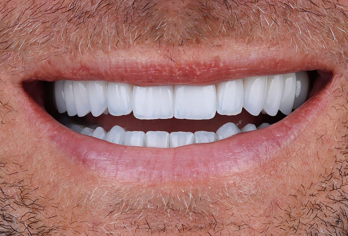 Completed ceramic smile